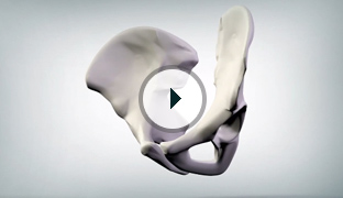 Advantages of Robotic Assisted Hip surgery