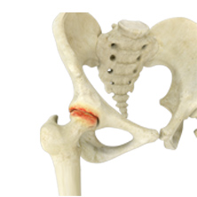 Hip Arthritis