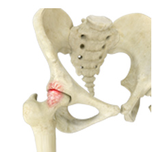 Hip Impingement