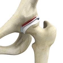 Hip Labral Tears