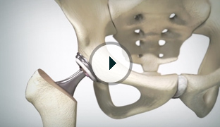 Recovery After Hip Replacement